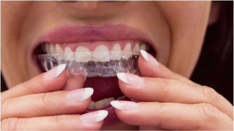 Mouth Guard FAQs: Common Questions About Teeth Grinding Protection