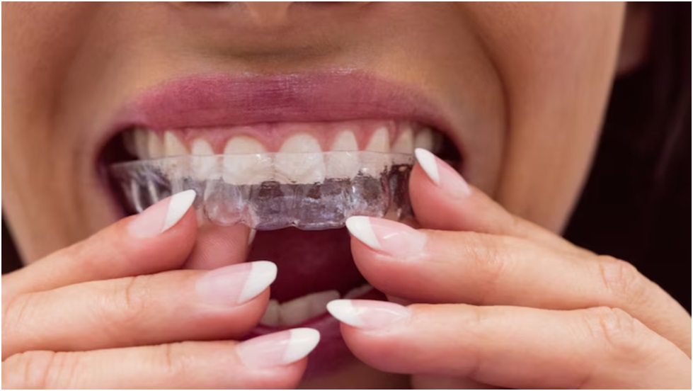 Mouth Guard FAQs: Common Questions About Teeth Grinding Protection