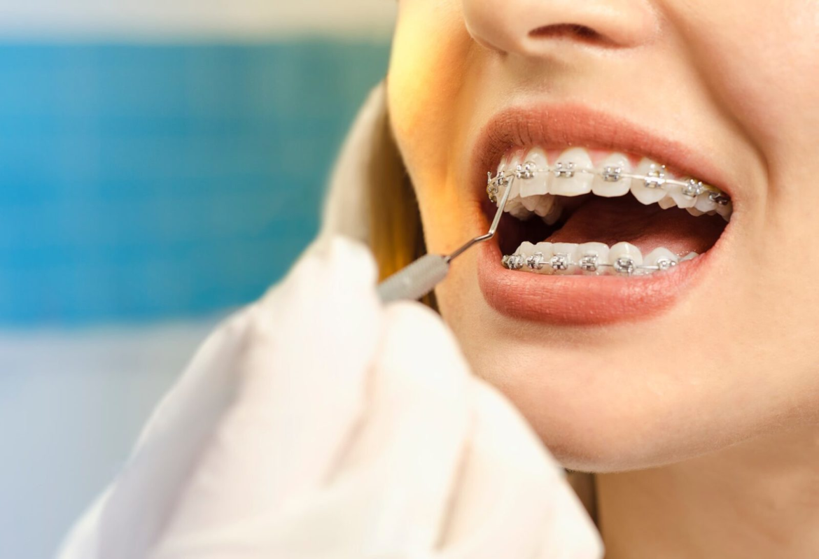 How Ceramic Braces Can Give You a Discreet Smile Upgrade